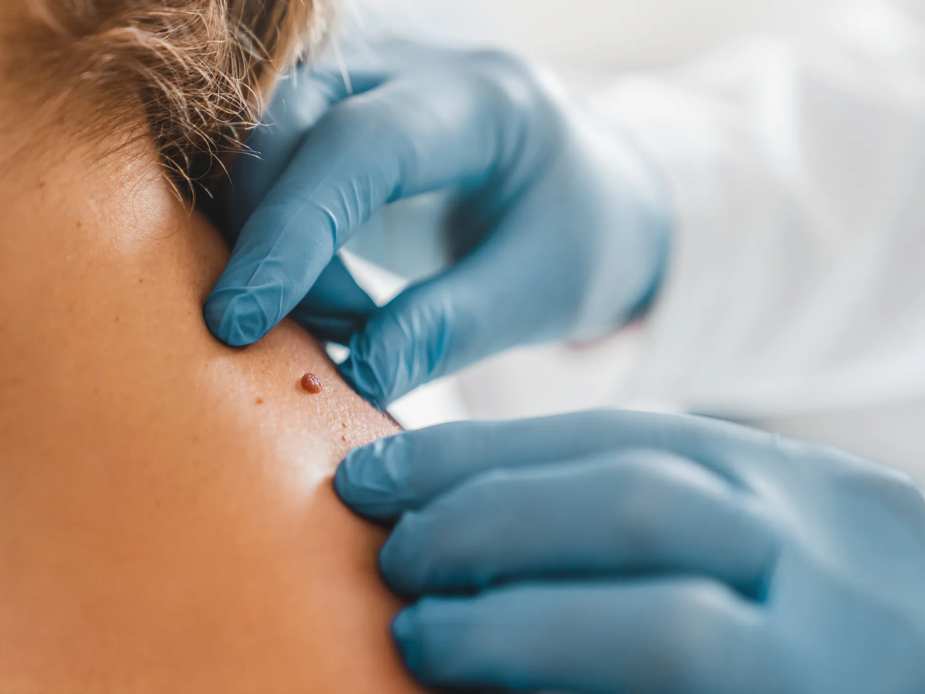 Gloved clinician examining a raised skin lesion on the neck